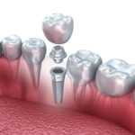 implant image