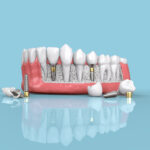 tooth-replacements