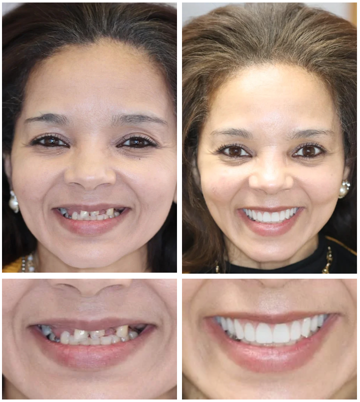 Dental Veneers Philadelphia